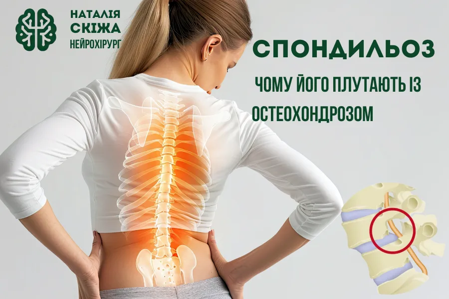 Спондильоз: чому його плутають із остеохондрозом спондильоз 1