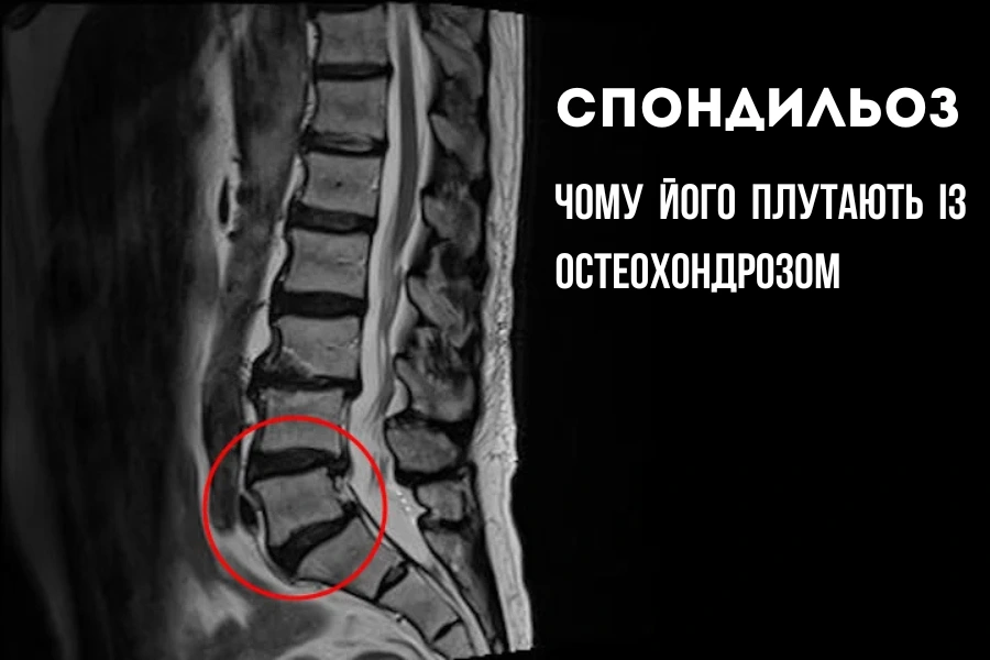 Спондильоз: чому його плутають із остеохондрозом