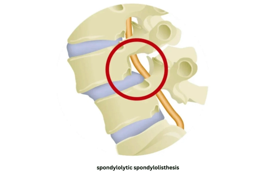 Лікування спондильозу в Києві