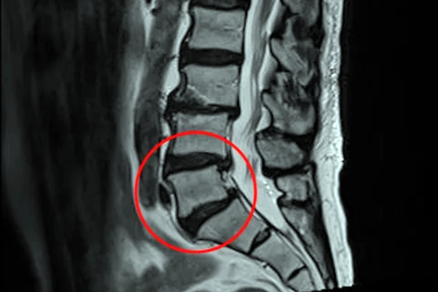 Спондильоз: чому його плутають із остеохондрозом