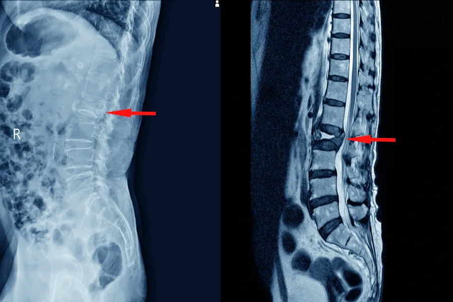 Стеноз хребетного каналу: симптоми, МРТ-діагностика та лікування Стеноз хребетного каналу: симптоми, МРТ-діагностика та лікування - Нейрохірург Наталія Скіжа 2025