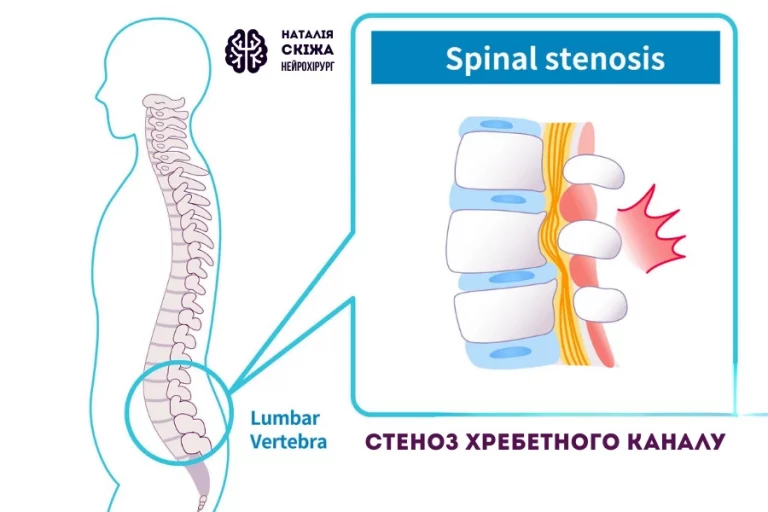 стеноз хребетного каналу 4