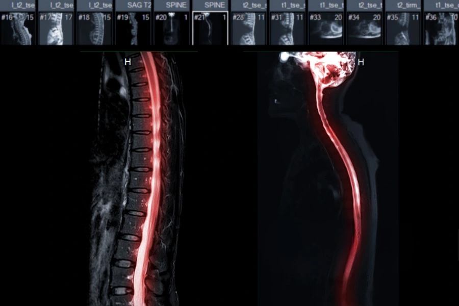 Діагностика стенозу хребетного каналу Діагностика стенозу хребетного каналу