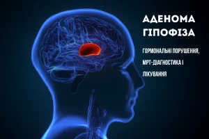 аденома гіпофіза наталія скіжа нейрохірург 1