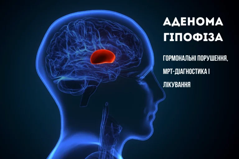 аденома гіпофіза наталія скіжа нейрохірург 1