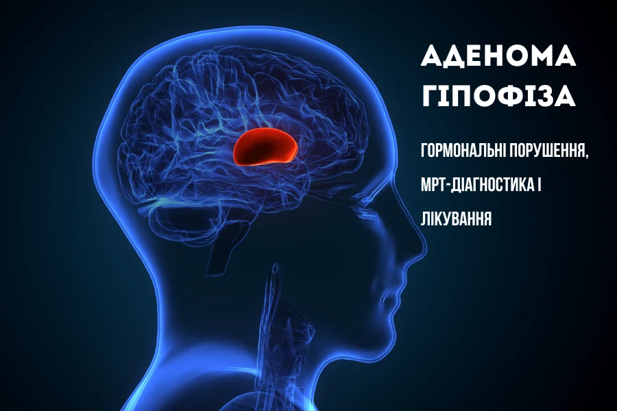 аденома гіпофіза наталія скіжа нейрохірург 1