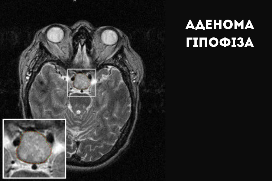 Аденома гіпофіза: гормональні порушення, МРТ-діагностика і лікування