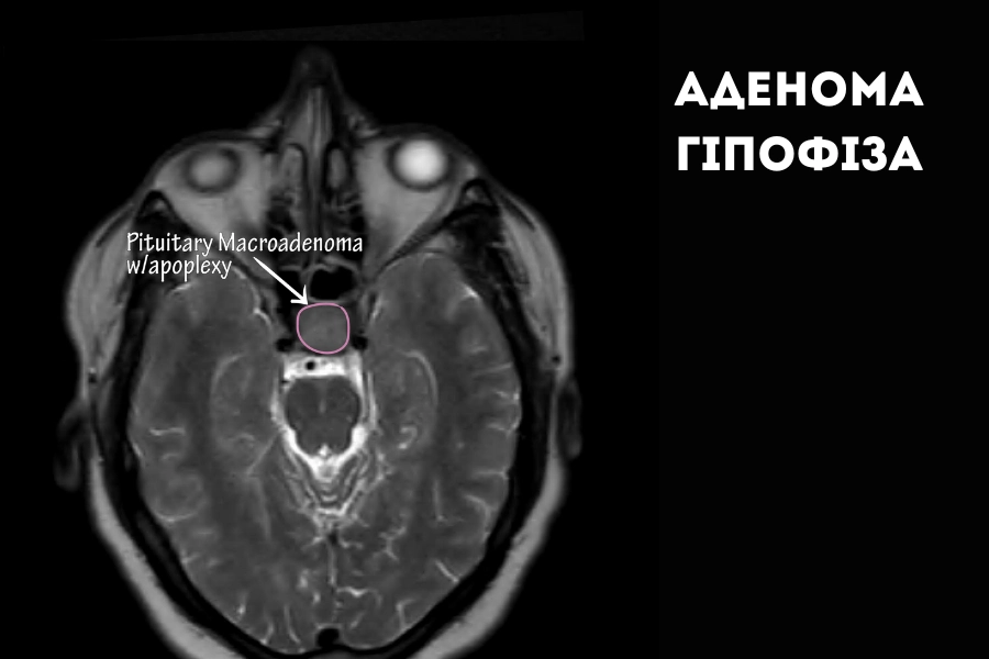 Що таке аденома гіпофіза
