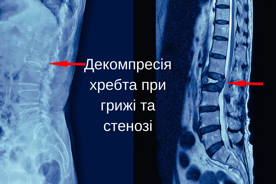 Декомпресія хребта при грижі та стенозі: коли потрібна операція і що дає лікування декомпресія хребта при грижі та стенозі 1