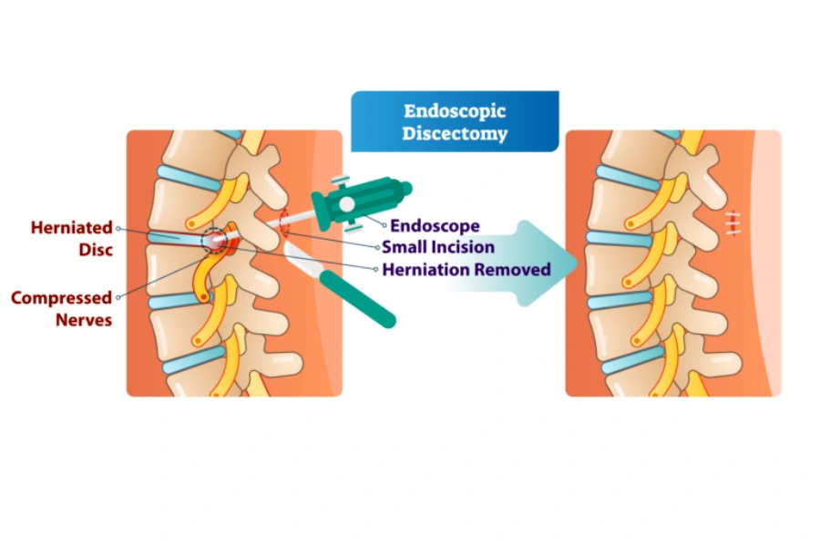 Хірургічні методи декомпресії Хірургічні методи декомпресії