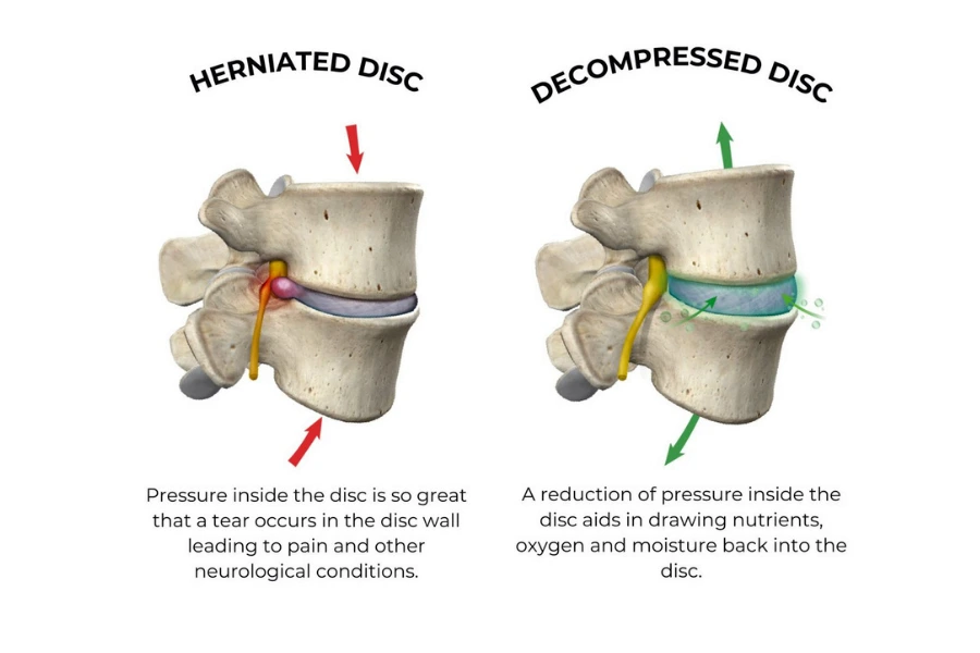 Причини компресії нервів Причини компресії нервів