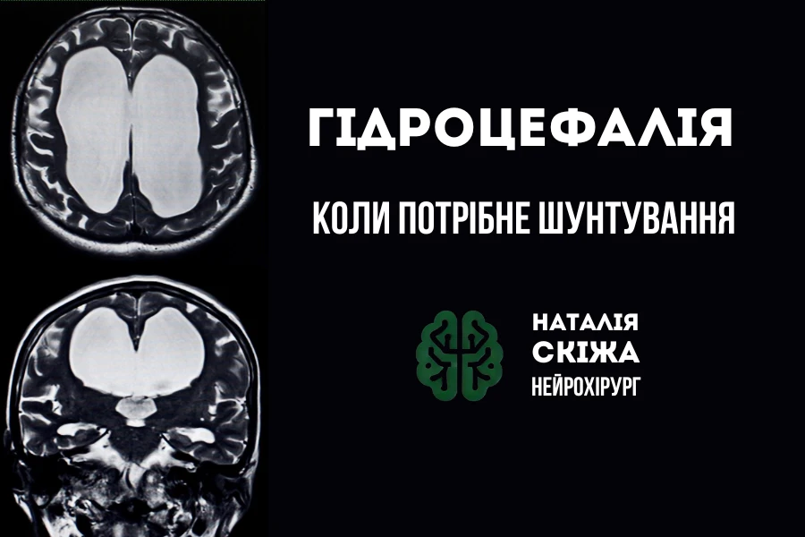 гідроцефалія наталія скіжа нейрохірург 1