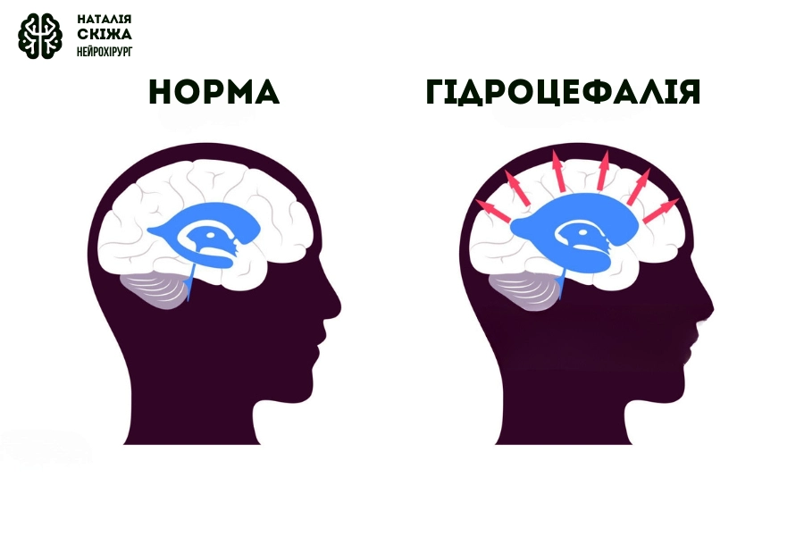 гідроцефалія наталія скіжа нейрохірург 2