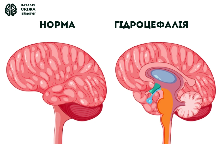 Симптоми підвищеного внутрішньочерепного тиску клінічні прояви гідроцефалії