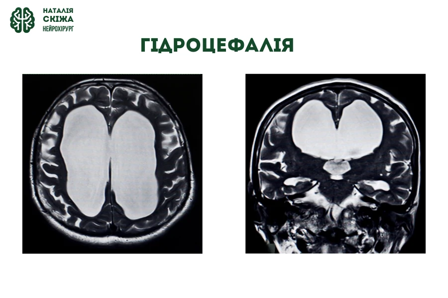 МРТ головного мозку - Методи діагностики гідроцефалії