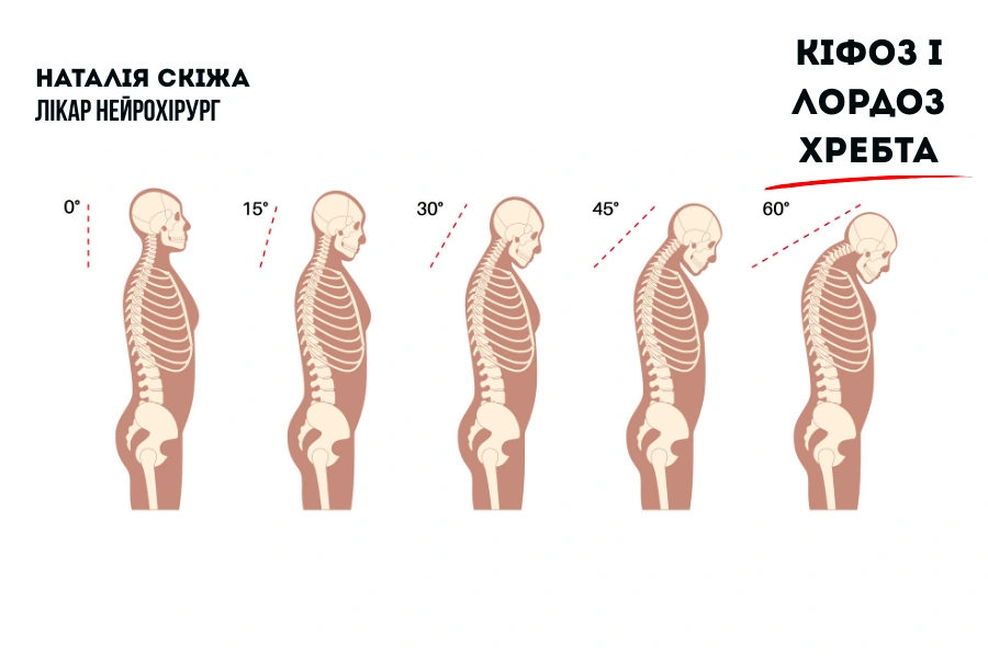 Кіфоз і лордоз: Природні вигини хребта Кіфоз і лордоз: Природні вигини хребта