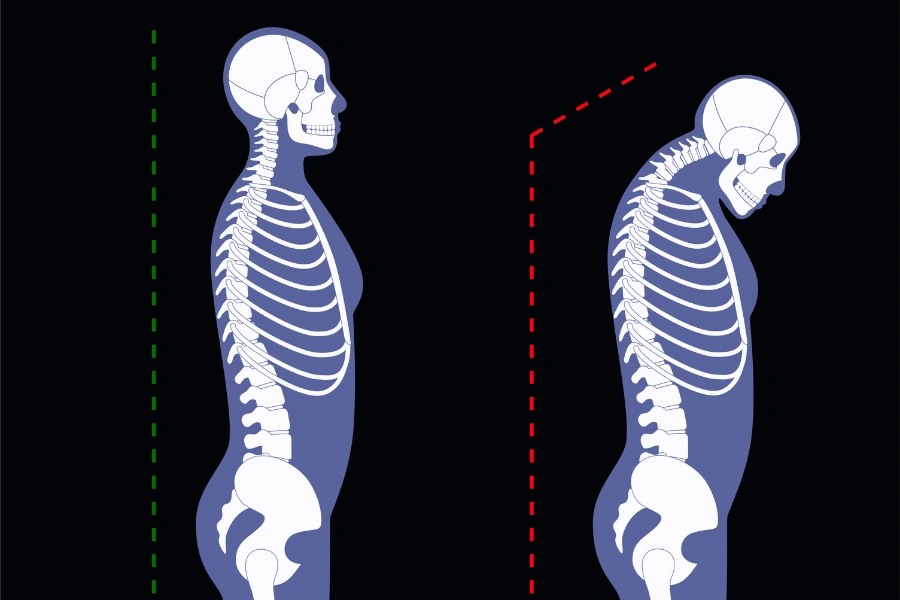 Кіфоз і лордоз хребта - Методи корекції Кіфоз і лордоз хребта - Методи корекції