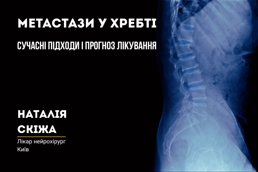 Метастази у хребті: сучасні підходи і прогноз лікування