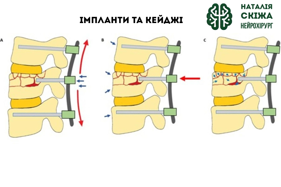 Силова діаграма конструкції «педикульні гвинти — стрижень», імплантованої з використанням нашої методики. (A) Збільшені сагітальні та спрямовані наперед сили внаслідок використання увігнутого стрижня та коротшого, виступаючого (proud) розташування проміжного педикульного гвинта. (B) Сили, спрямовані наперед, від конструкції «гвинт–стрижень» із реактивними силами, спрямованими назад, з боку переднього зв’язкового комплексу та періостальної манжетки, що сприяє зближенню уламків вибухового перелому та інтактної кісткової тканини. (C) Міжуламкові рухи фрагментів при вибуховому переломі. Силова діаграма конструкції «педикульні гвинти — стрижень», імплантованої з використанням нашої методики.
(A) Збільшені сагітальні та спрямовані наперед сили внаслідок використання увігнутого стрижня та коротшого, виступаючого (proud) розташування проміжного педикульного гвинта.
(B) Сили, спрямовані наперед, від конструкції «гвинт–стрижень» із реактивними силами, спрямованими назад, з боку переднього зв’язкового комплексу та періостальної манжетки, що сприяє зближенню уламків вибухового перелому та інтактної кісткової тканини.
(C) Міжуламкові рухи фрагментів при вибуховому переломі.