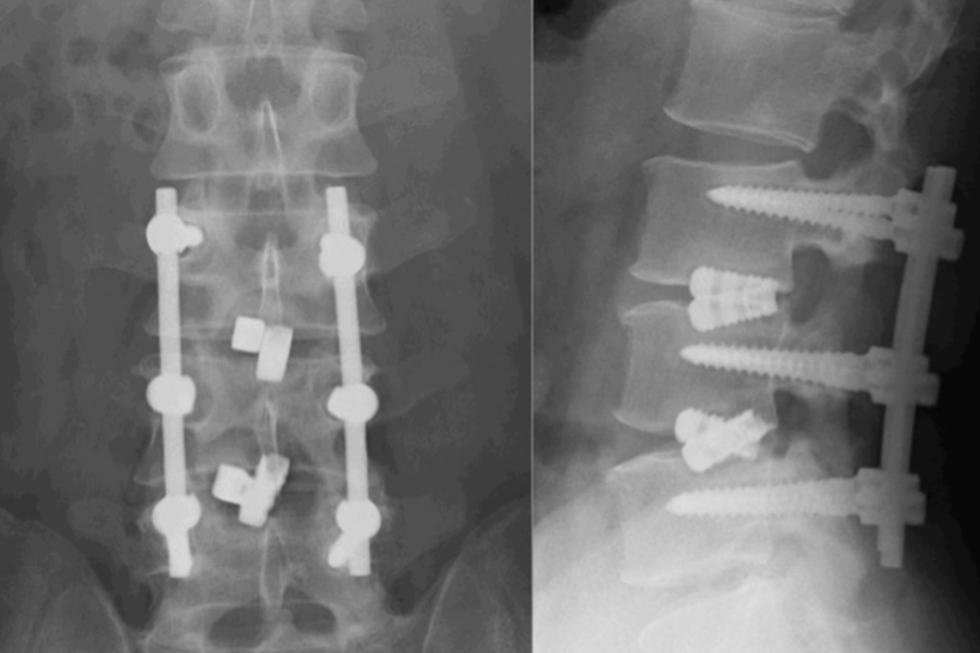 Транспедикулярна фіксація хребта: що це і коли потрібна Транспедикулярна фіксація хребта: що це і коли потрібна