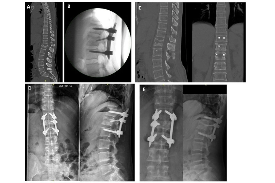 Перед-, інтра- та післяопераційні рентгенологічні зображення пацієнта з флексійно-дистракційною травмою хребта з елементами вибухового перелому. (A) Передопераційна комп’ютерна томографія (КТ), сагітальна проєкція. (B) Інтраопераційна корекція: рентгенограма в сагітальній проєкції. (C) Негайна післяопераційна комп’ютерна томографія (КТ), сагітальна та корональна проєкції. (D) Контрольне обстеження через 6 місяців: передньо-задня та бокова проєкції. (E) Контрольне обстеження через 2 роки: передньо-задня та бокова проєкції. Перед-, інтра- та післяопераційні рентгенологічні зображення пацієнта з флексійно-дистракційною травмою хребта з елементами вибухового перелому.
(A) Передопераційна комп’ютерна томографія (КТ), сагітальна проєкція.
(B) Інтраопераційна корекція: рентгенограма в сагітальній проєкції.
(C) Негайна післяопераційна комп’ютерна томографія (КТ), сагітальна та корональна проєкції.
(D) Контрольне обстеження через 6 місяців: передньо-задня та бокова проєкції.
(E) Контрольне обстеження через 2 роки: передньо-задня та бокова проєкції.