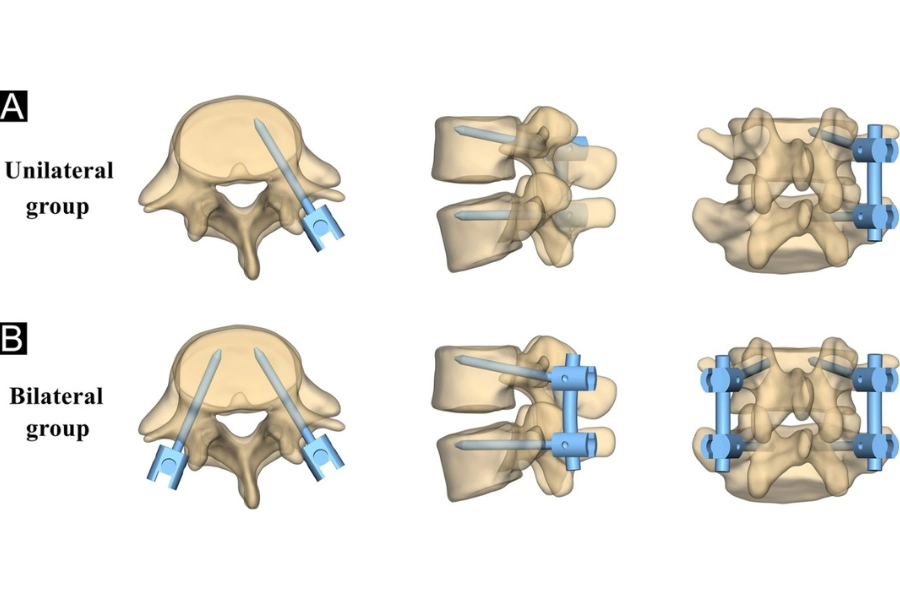 Транспедикулярна фіксація хребта: що це і коли потрібна Транспедикулярна фіксація хребта: що це і коли потрібна - Нейрохірург Наталія Скіжа 2026