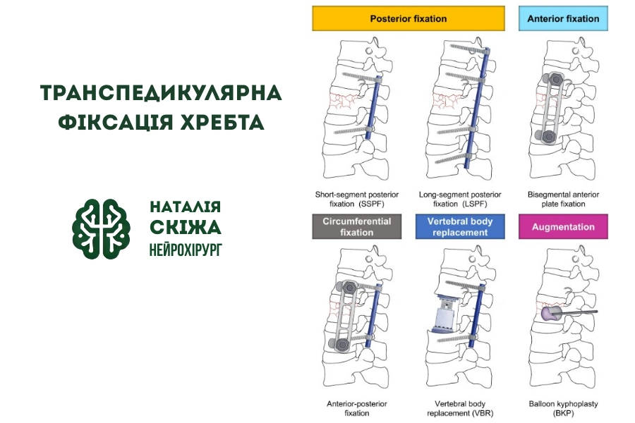 Транспедикулярна фіксація хребта: що це і коли потрібна Транспедикулярна фіксація хребта: що це і коли потрібна