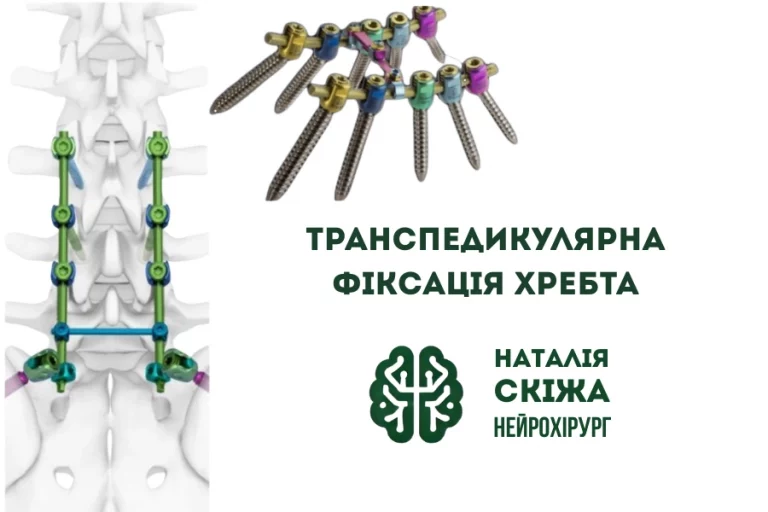 Транспедикулярна фіксація хребта: що це і коли потрібна - Нейрохірург Наталія Скіжа 2026