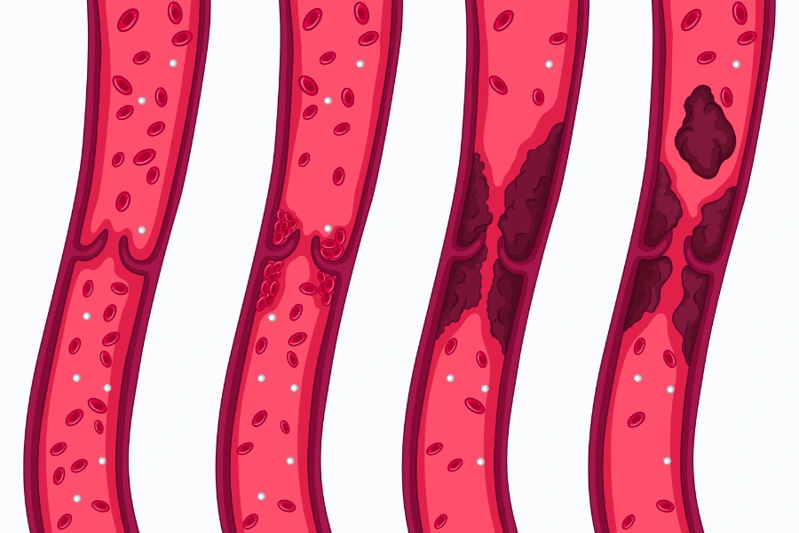 Коли призначають аналіз на D-димер